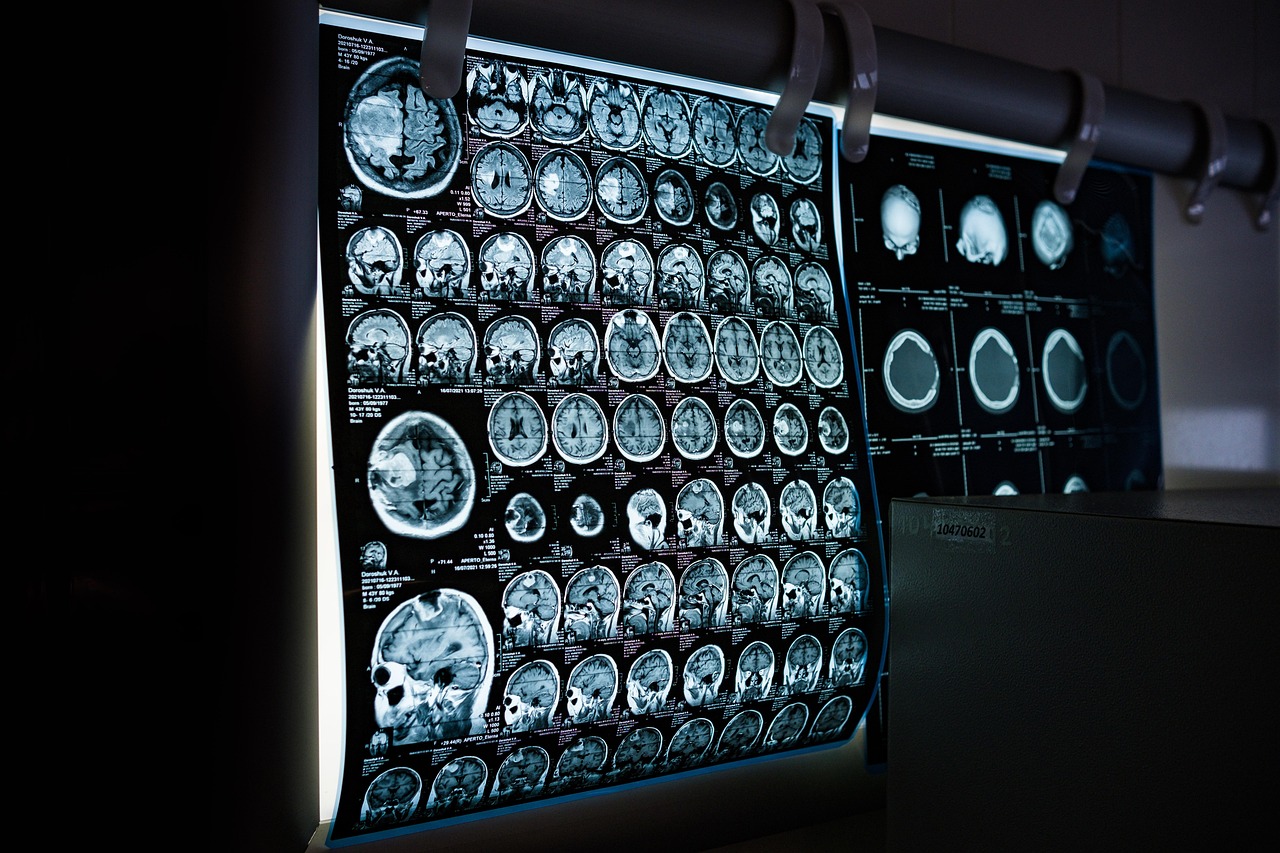 Illustratief beeld van hersenscans en medische technologie